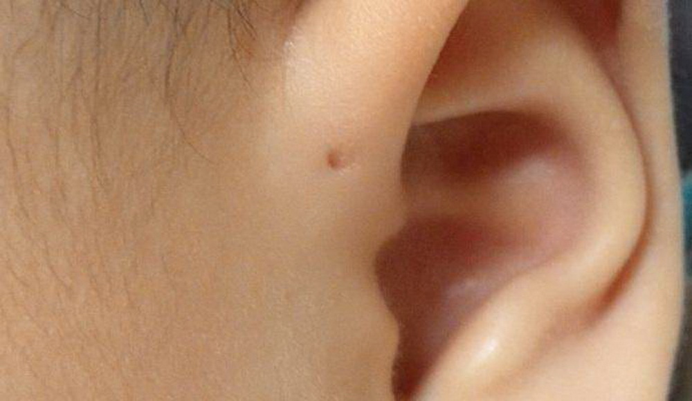 У каждого сотого британца нашли загадочные отверстия над ушами